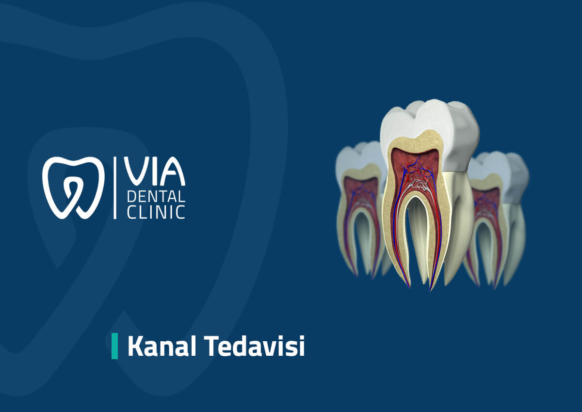 Kanal Tedavisi