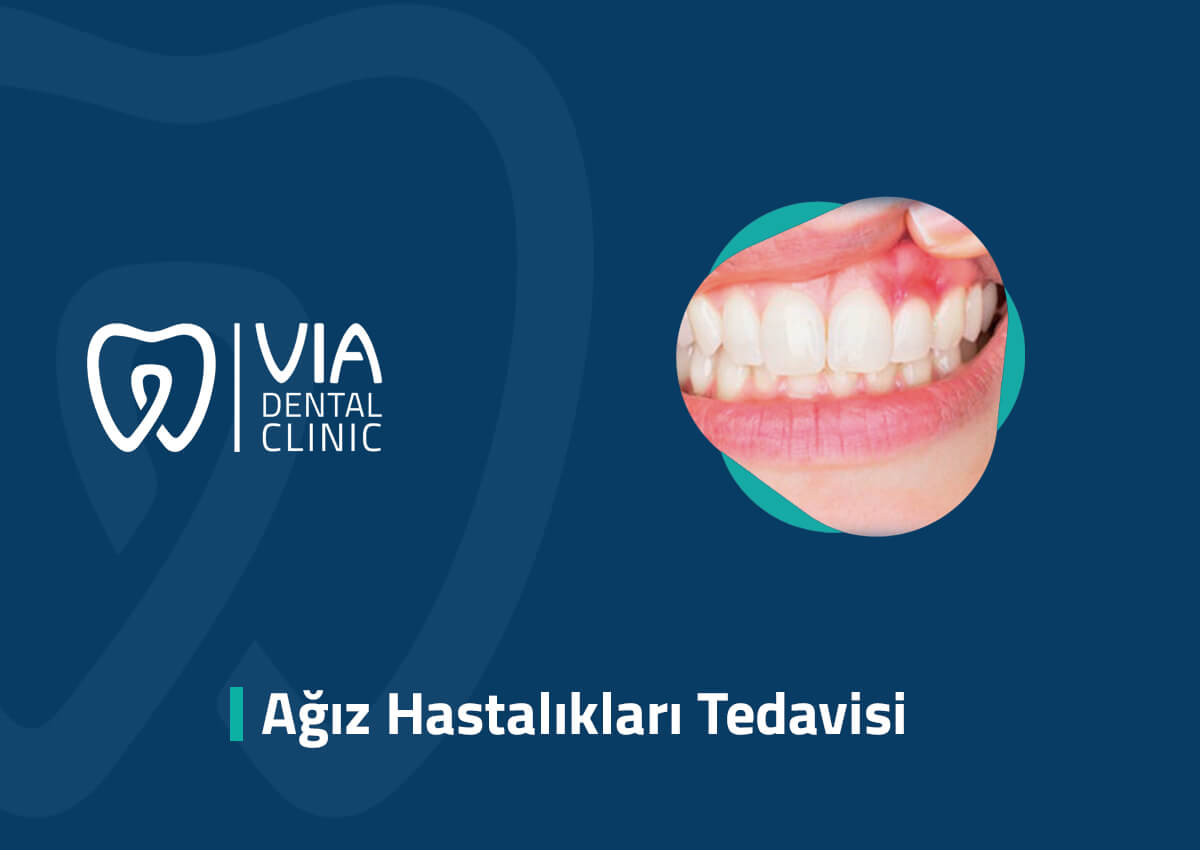Ağız Hastalıkları Tedavisi