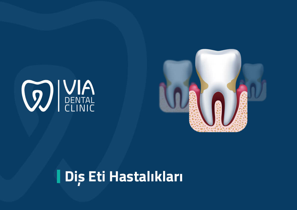 Diş Eti Hastalıkları